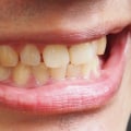 Are yellow stained teeth permanent?
