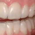 Will tooth whitening work on fillings?